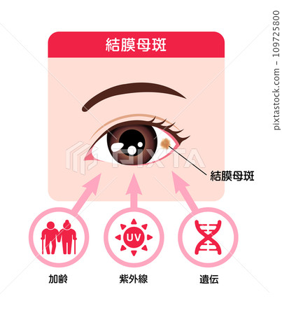 結膜痣向量圖的原因 結膜痣向量圖的原因 109725800