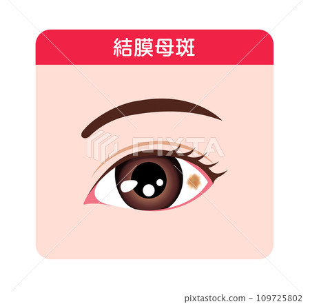 結膜痣(眼球放大圖)向量圖 結膜痣(眼球放大圖)向量圖 109725802