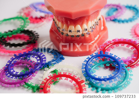Orthodontic ligatures rings and ties, elastic rubber bands on orthodontic braces, model for dentist studying about dentistry. 109737233