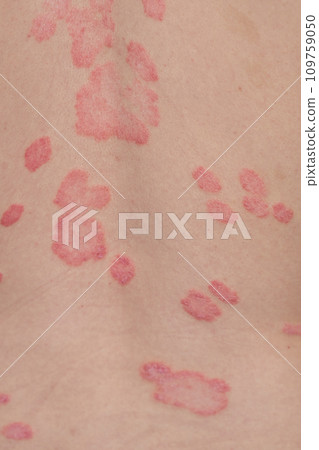 Psoriasis Vulgaris, skin patches are typically red, itchy, and scaly. Papules of chronic psoriasis vulgaris on male hand, back and body. Genetic immune disease. Detail of psoriatic skin disease  109759050