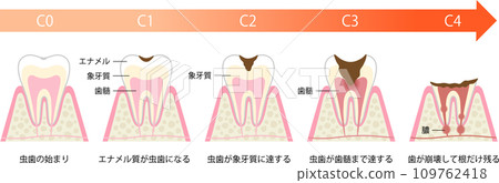 蛀牙的進展和症狀 109762418