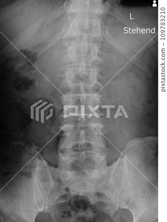 x-ray images spine x-ray images spine 109783210