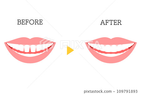 美容牙科，直接黏合前後，有間隙的前牙 109791893