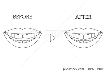 Cosmetic dentistry, before and after direct bonding, chipped teeth Cosmetic dentistry, before and after direct bonding, chipped teeth 109791901