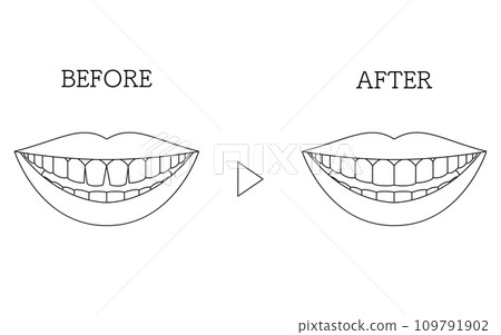 Cosmetic dentistry, before and after direct bonding, front teeth with gaps Cosmetic dentistry, before and after direct bonding, front teeth with gaps 109791902