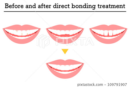 Cosmetic dentistry: Direct bonding treatment, cavities, chipped teeth, gapped teeth Cosmetic dentistry: Direct bonding treatment, cavities, chipped teeth, gapped teeth 109791907