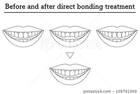 美容牙科：直接黏合治療、蛀牙、牙齒缺損、牙齒間隙 109791909