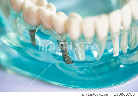 Dental implant, artificial tooth roots into jaw, root canal of dental treatment, gum disease, teeth model for dentist studying about dentistry. 109809799