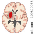 Horizontal cross section of cerebral hemorrhage 109820058