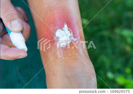 This is a photograph of a man applying antiseptic ointment to a red rash on his arm. 109820575