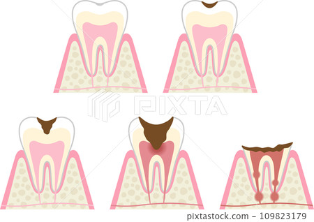 Progression and symptoms of tooth decay 109823179