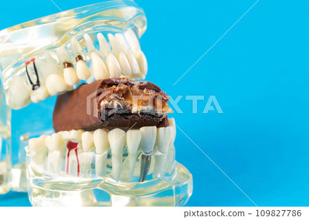 A bitten piece of chocolate in a dental jaw mockup on a blue background. The concept of the effect of sugar and leftover food on teeth and tooth enamel. Tooth destruction by bacteria, caries, pulpitis 109827786