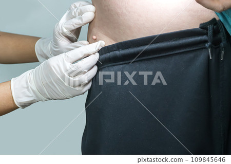 Skin tag or acrochondon or soft fibroma Skin tag or acrochondon or soft fibroma 109845646