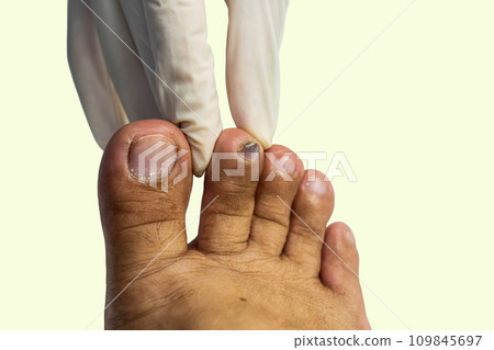 Toenail Subungual Hematoma 109845697