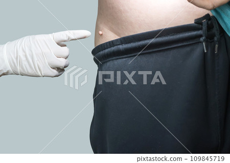 Skin tag or acrochondon or soft fibroma Skin tag or acrochondon or soft fibroma 109845719