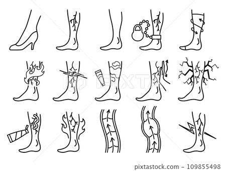 Varicose treatment icons set in coloring style. Violation of circulatory system. Vascular disease diagnostic. Venous insufficiency medical disease. Vector illustration 109855498