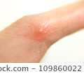 Image material of a finger with symptoms of red blisters and a white background 109860022