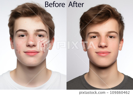 Teenage boy before and after acne treatment on white background Teenage boy before and after acne treatment on white background 109860462