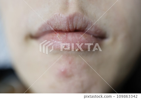 20多歲女性嘴唇乾燥,少量出血 20多歲女性嘴唇乾燥,少量出血 109863342