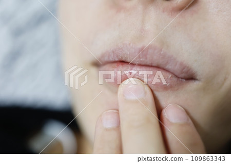 20多歲女性嘴唇乾燥,少量出血 20多歲女性嘴唇乾燥,少量出血 109863343