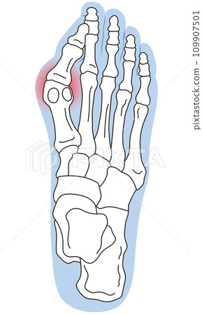 Bunion stage foot bone skeletal diagram 109907501