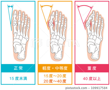 Bunion stage foot bone skeletal diagram Bunion stage foot bone skeletal diagram 109917584
