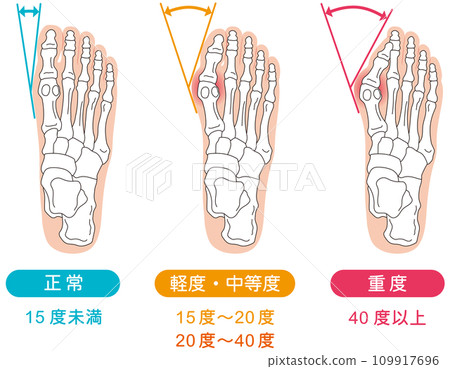 拇囊炎階段足骨骨骼圖 拇囊炎階段足骨骨骼圖 109917696