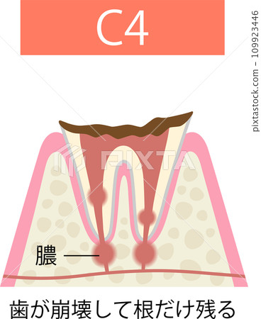 Tooth decay C4 The tooth decays and only the tooth root remains 109923446