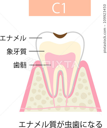 C1 Enamel caries 109923450