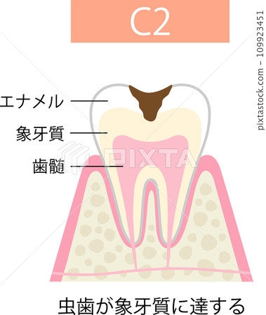 C 2 牙本質齲齒 109923451
