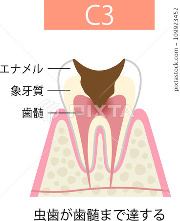 C3 Cavities reach the pulp of the tooth C3 Cavities reach the pulp of the tooth 109923452