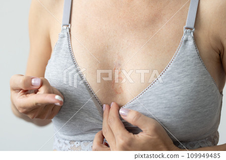 Woman in a bra for breastfeeding has allergy on her chest, holding cream for healing on her finger. Closeup. 109949485