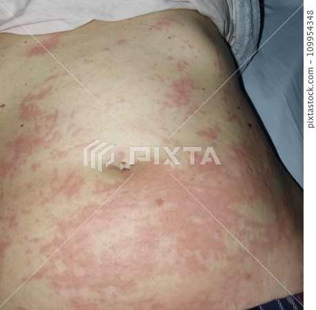 Female abdomen affected by a severe allergic reaction, dermatitis Female abdomen affected by a severe allergic reaction, dermatitis 109954348