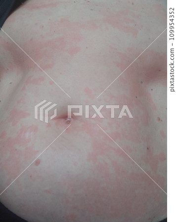 Female abdomen affected by a severe allergic reaction, dermatitis 109954352