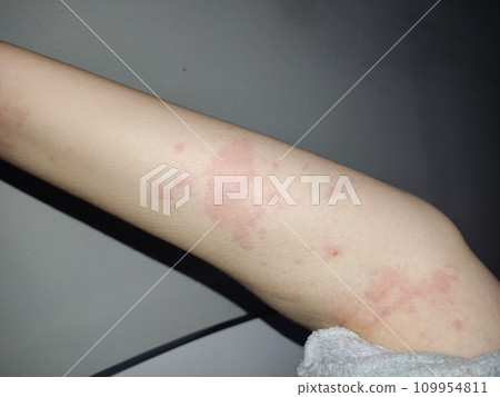 Female body affected by a severe allergic reaction, dermatitis 109954811