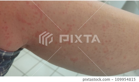 Female body affected by a severe allergic reaction, dermatitis Female body affected by a severe allergic reaction, dermatitis 109954815