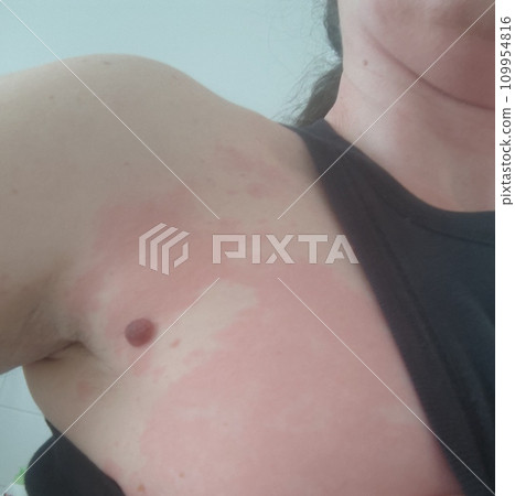 Female body affected by a severe allergic reaction, dermatitis 109954816