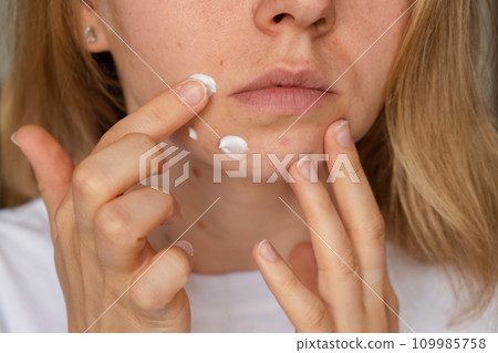 Unrecognizable woman applies makeup, cream serum cure for acne on face. Close-up acne on woman's face with rash skin ,scar and spot that allergic to cosmetics. Problem skincare and health concept 109985758