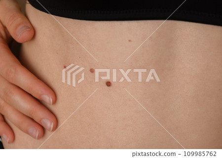 Unrecognizable woman showing her Birthmarks on skin Close up detail of the bare skin Sun Exposure effect on skin, Health Effects of UV Radiation Woman with birthmarks Pigmentation 109985762