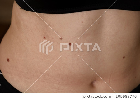 Unrecognizable woman showing her Birthmarks on skin Close up detail of the bare skin Sun Exposure effect on skin, Health Effects of UV Radiation Woman with birthmarks Pigmentation 109985776