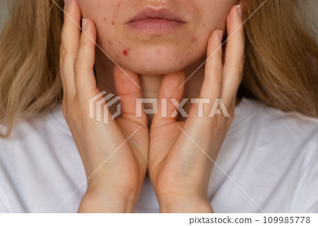 Unrecognizable woman showing her acne on face. Close-up acne on woman's face with rash skin ,scar and spot that allergic to cosmetics. Problem skincare and health concept. Wrinkles, melasma, dark Unrecognizable woman showing her acne on face. Close-up acne on woman's face with rash skin ,scar and spot that allergic to cosmetics. Problem skincare and health concept. Wrinkles, melasma, dark 109985778