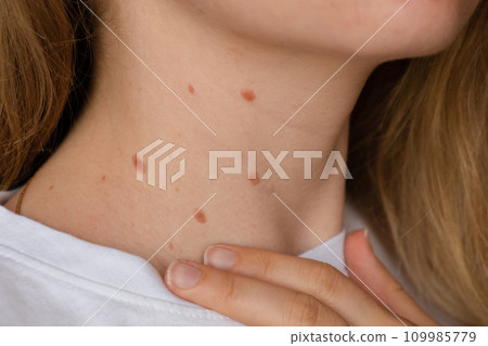 Unrecognizable woman showing her Birthmarks on neck skin Close up detail of the bare skin Sun Exposure effect on skin, Health Effects of UV Radiation Woman with birthmarks Pigmentation 109985779