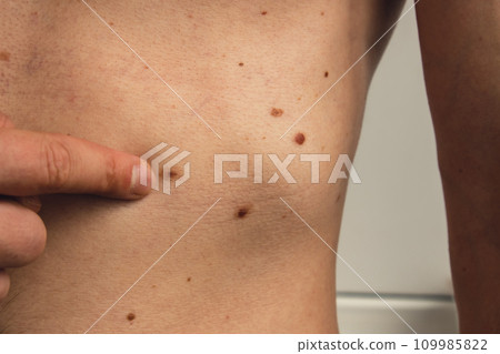 Unrecognizable man showing his birthmarks on skin Close up detail of the bare skin Sun Exposure effect on skin. Health Effects of UV Radiation Male with birthmarks Pigmentation Unrecognizable man showing his birthmarks on skin Close up detail of the bare skin Sun Exposure effect on skin. Health Effects of UV Radiation Male with birthmarks Pigmentation 109985822
