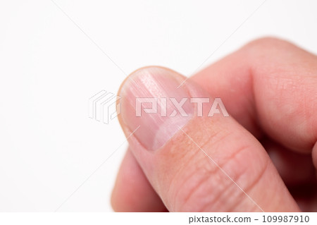 指甲上有垂直條紋(垂直甲板) 指甲上有垂直條紋(垂直甲板) 109987910