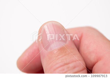 指甲上有垂直條紋（垂直甲板） 109987913