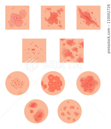 Different types of psoriasis vector set. Part of patients skin with dermatitis, inflammation, red rash and other skin problems. Cartoon illustration for disease concept 110002726