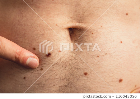 Unrecognizable man showing his birthmarks on skin Close up detail of the bare skin Sun Exposure effect on skin. Health Effects of UV Radiation Male with birthmarks Pigmentation 110045056