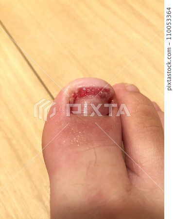 Broken right big toe nail Broken right big toe nail 110053364