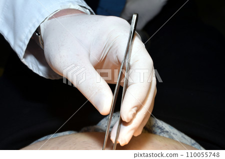 The doctor's hand holds tweezers. 110055748