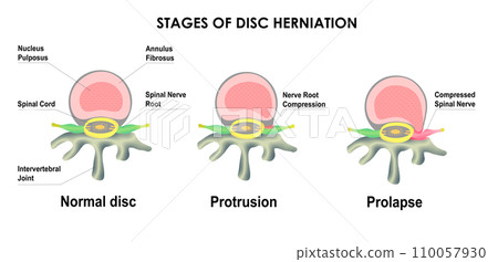 Difference between Bulging Disc and Herniated Disc. Stages of Spinal Disc extrusion. Difference between Bulging Disc and Herniated Disc. Stages of Spinal Disc extrusion. 110057930